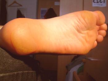 Ampollas en los dedos de los pies y pies: prevención y tratamiento.