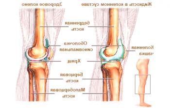 Черен дроб в коляното: възможни причини и лечение