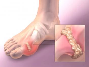 Ayuda oportuna con artrosis del dedo del pie.