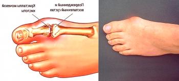 Manifestaciones de depósitos de sal en el pie y tratamiento de la enfermedad.