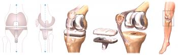 Matices de rehabilitación después de la cirugía para endoprótesis de la articulación de la rodilla.