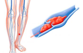 Simptomi in zdravljenje tromboflebitisa globokih žil spodnjih okončin