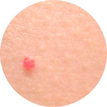 Majhne rdeče pike na koži: vzroki in zdravljenje