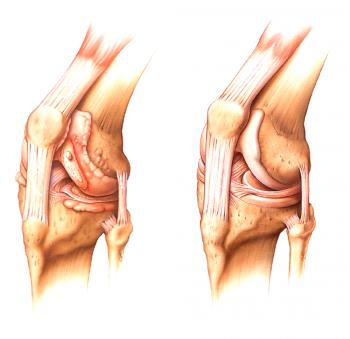 Causas y tipos de artritis de la articulación de la rodilla.