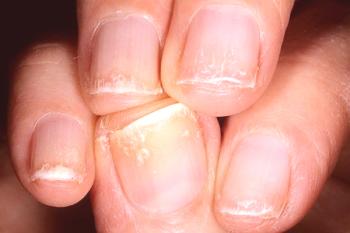 Causas y métodos de lucha contra las bandas de uñas.