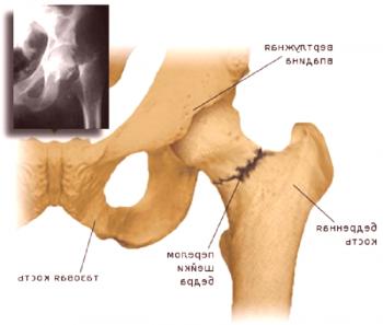 Causas y consecuencias de la fractura de cadera.