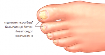 Remedios populares efectivos contra el hongo de las uñas en las piernas.