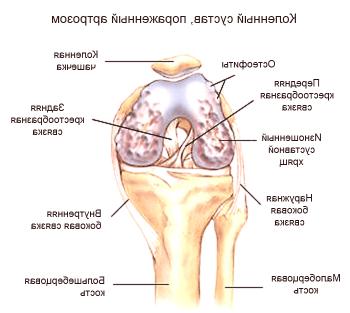 Osteofitos de la articulación de la rodilla: cómo tratar y qué es.