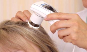 Diagnoza izgube las pri ženskah in moških, pregled stanja kodre