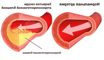 Enfermedades de los vasos sanguíneos de las extremidades inferiores.