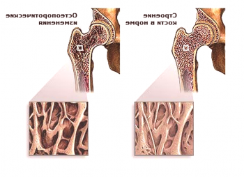 Kaj je osteoporoza kolčnega sklepa?