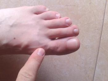 Cómo tratar la gota en el dedo gordo del pie.