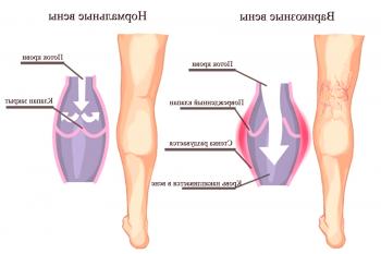 Tratamiento y signos de varices en las piernas.