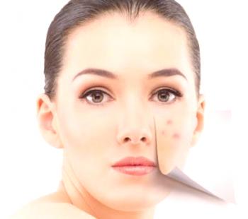 Tintura de propóleos del acné: remedio natural para la cosmetología.