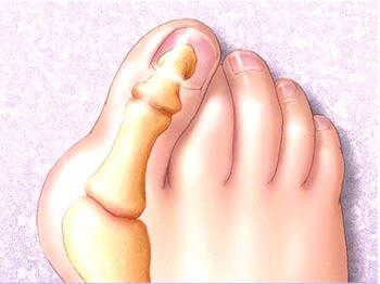 Cambios de deformación y conos en los dedos: métodos de tratamiento.
