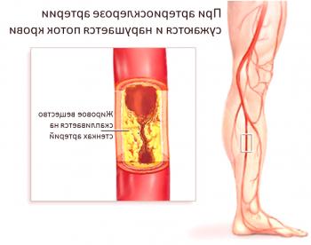 Zakaj je izbrisna ateroskleroza žil spodnjih okončin?