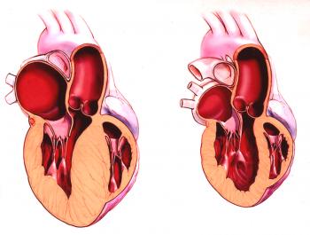 Хипертрофия на лявата камера на сърцето, какво е това и как да се лекува?