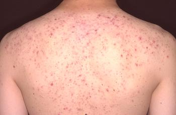 Cómo deshacerse del acné en la espalda: consejos importantes