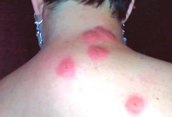 Alergija na ugriz žuželke: simptomi in zdravljenje (foto)