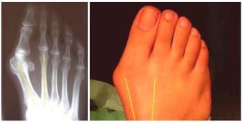 Desarrollo de la deformidad en valgo del pulgar del pie y su tratamiento sin cirugía.
