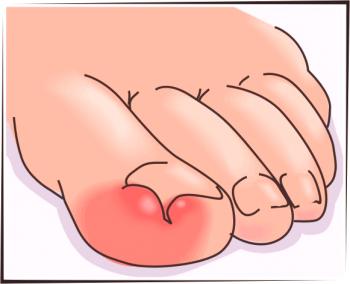 ¿Cómo eliminar el pus bajo el clavo en el dedo gordo?