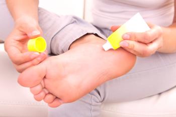 Características del tratamiento del hongo del pie.