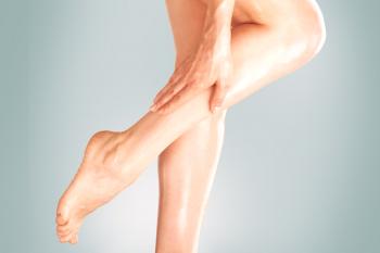 ¿Qué síntomas acompañan el dolor en las piernas con venas varicosas?