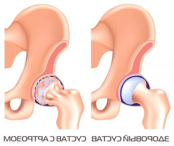 Stopnja artroze kolčnega sklepa