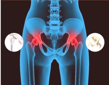 Artrosis de la articulación de la cadera: principales causas y síntomas de la enfermedad.