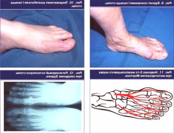 Bursitis stopala: simptomi, vzroki, zdravljenje