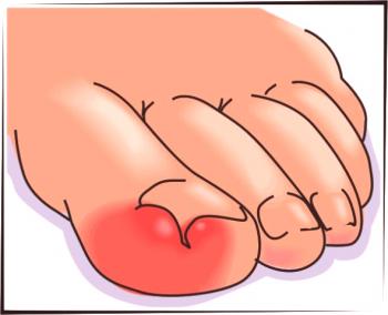 Preprečevanje in zdravljenje onychocryptosis - vraščeni noht na palcu