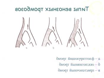 Educación y tratamiento de las trombosis en las venas de las piernas.