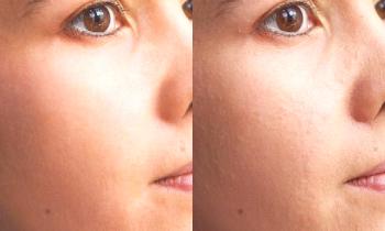 Vse prednosti in slabosti postopkov za atraumatsko čiščenje kože obraza