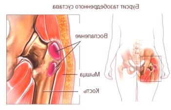 Los principales síntomas de la bursitis de cadera.