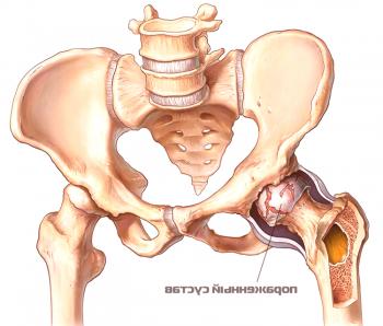 Síntomas evidentes de coxartrosis de la articulación de la cadera y su tratamiento.