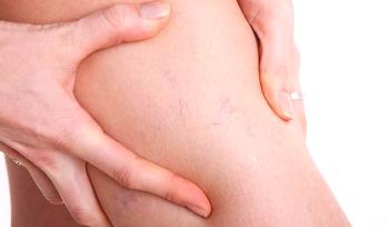 Causas y tratamiento de los asteriscos vasculares en las piernas.