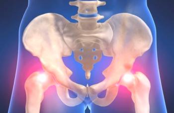 Coxartrosis de la articulación de la cadera: medicina popular