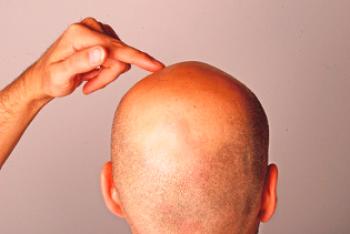 Частична загуба на коса при мъже и жени: причини и лечение
