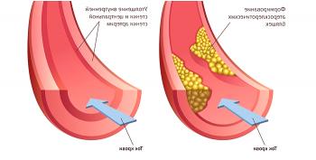 Ateroesclerosis con stent: cuando los vasos de las extremidades inferiores se ven afectados