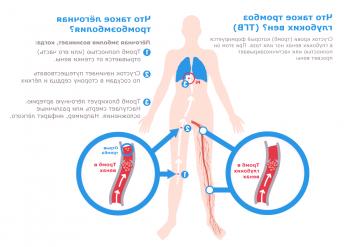 Causas, síntomas y tratamiento de la trombosis venosa profunda de las extremidades inferiores.