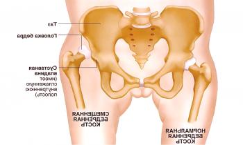 Características de la dislocación de la articulación de la cadera en niños y adultos.