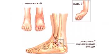 Mecanismo y tratamiento de la dislocación del pie.