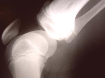 Artrosis deformante de la articulación de la rodilla: causas, tratamiento